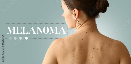 Tableau sur toile Young woman with moles and word MELANOMA on grey background