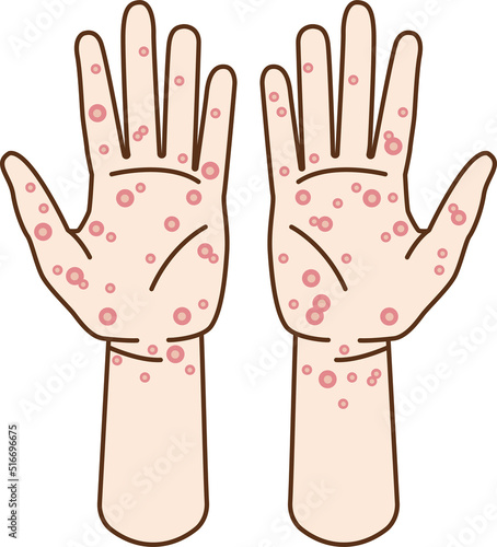Clip art of hand of syphilis and skin disease