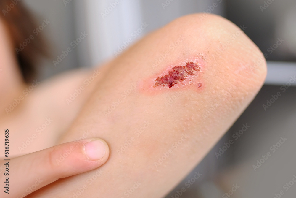 healing wound on child's hand, crusted abrasion in elbow area, scar, traumatic safety concept for children, treatment of injuries, medical care, health risk, bacterial contamination of the abrasion healing wound on child's hand, crusted abrasion in elbow area, scar, traumatic safety concept for children, treatment of injuries, medical care, health risk, bacterial contamination of the abrasion