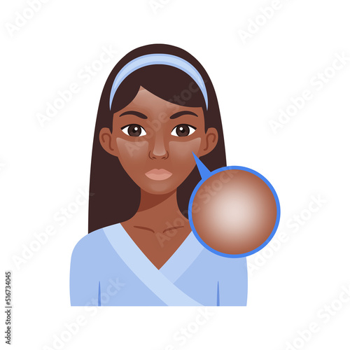 Oily Skin on the Female Face. Beautiful Afro Black Woman with Oily Skin. Analysis. Greasy Shine. Skin Problem. Zoom. Color Cartoon style. White background. Vector illustration for Beauty Design.
