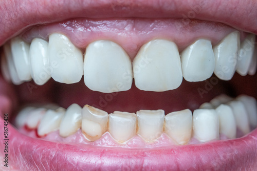 Caucasian male open mouth showing row of white teeth and back of the throat. Close up macro shot, unrecognizable face