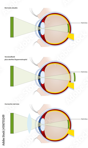 hyperopia