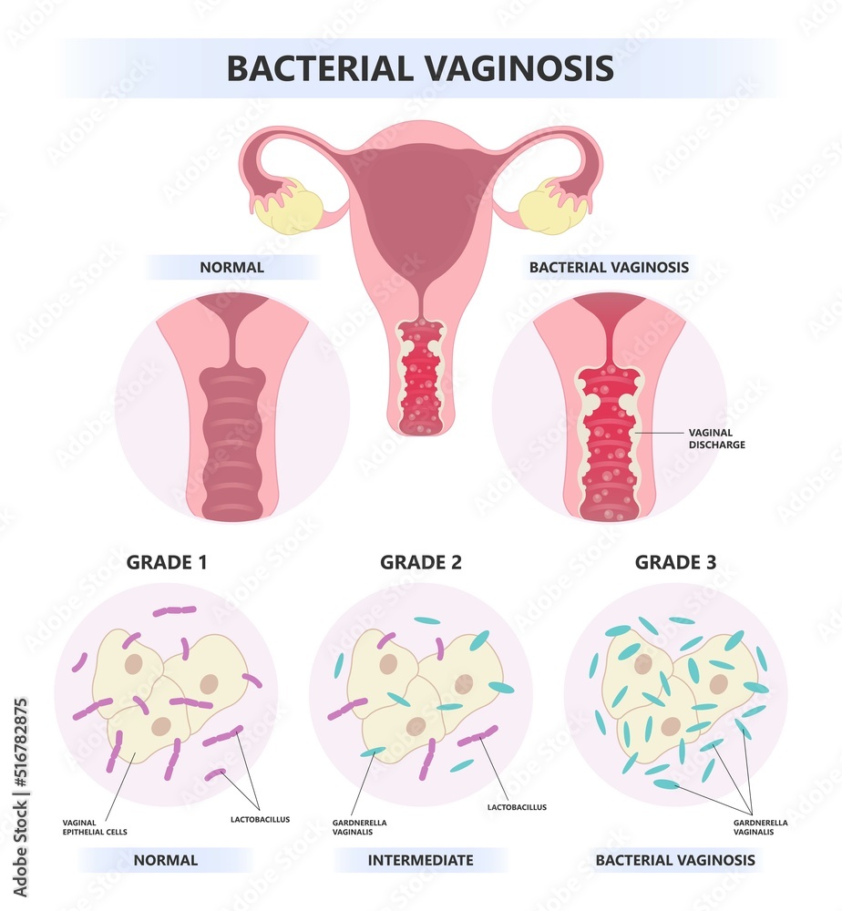 HIV or AIDS with Vagina bacterial sex odor fishy Foul smelling good Preterm birth of herpes simplex virus and Pelvic trich cervix yeast pap smear cancer pain rash lactic acid tract syndrome atrophy HIV or AIDS with Vagina bacterial sex odor fishy Foul smelling good Preterm birth of herpes simplex virus and Pelvic trich cervix yeast pap smear cancer pain rash lactic acid tract syndrome atrophy