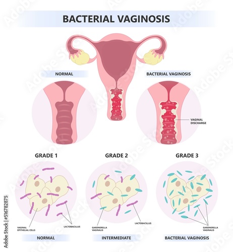 HIV or AIDS with Vagina bacterial sex odor fishy Foul smelling good Preterm birth of herpes simplex virus and Pelvic trich cervix yeast pap smear cancer pain rash lactic acid tract syndrome atrophy photo