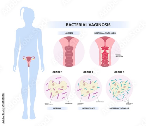 lactic acid With Vagina bacterial sex odor fishy Foul smelling good Preterm birth of HIV AIDS herpes simplex virus and Pelvic trich cervix yeast pap smear cancer pain rash tract syndrome atrophy