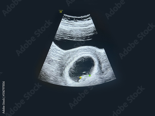 Little baby ultrasound at 8 weeks gestation ultrasound images of the baby or fetus and pregnancy health check.