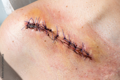 Schilderij op canvas Suture wound after fracture of the right clavicle after surgery, close up image