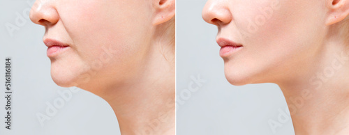 Obraz na plátně Female double chin before and after correction