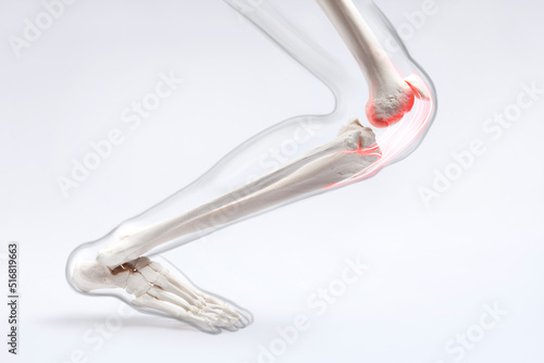Knee ligament and meniscus, human leg, medically accurate representation of an arthritic knee joint