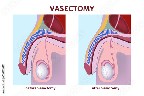 Vasectomy. Prevention of unwanted pregnancy. Severed seminal ducts. Diagram with the anatomy of the male reproductive system. Medical poster. Vector illustration photo