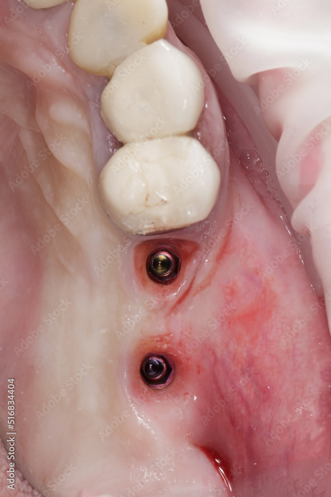 Fototapeta premium two dental implants in the gum before installing two crowns