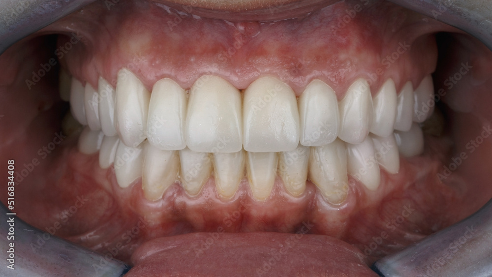 excellent dental photo with temporary plastic crowns in the oral cavity Stock Photo Adobe Stock