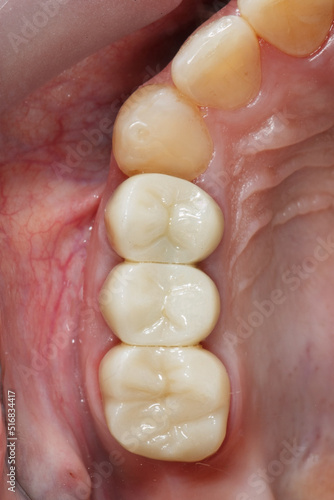 three beautiful dental crowns with zircon morphology in the chewing region of the jaw