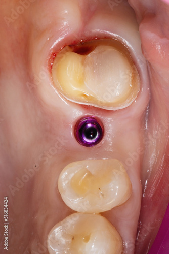 prepared tooth for a crown and an implant for a crown