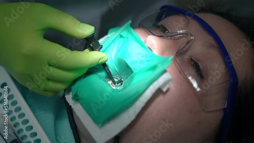Close-up inserting protaper in root canal of patient in dental chair. Headshot portrait of Caucasian woman in dental dam and eyeglasses undergoing endodontic treatment in hospital. Slow motion photo