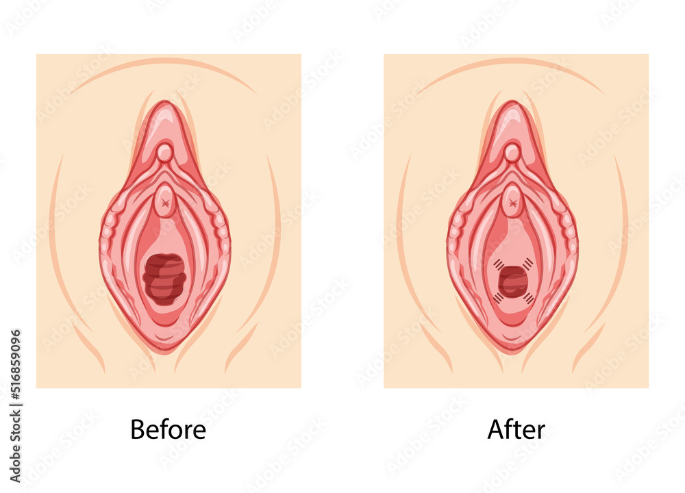 before ad after sex Hymenoplasty before and after Hymen repair restoration revirginization  reproductive system uterus. Front view. Human Surface anatomy of perineum  external organs scheme, vagina vulva flat style icon Stock ベクター | Adobe  Stock
