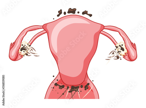 Endometriosis 3 stage Female reproductive system Front view. Human anatomy internal organs scheme, cervix, ovary, fallopian tube flat style icon. Vector illustration Realistic color concept isolated