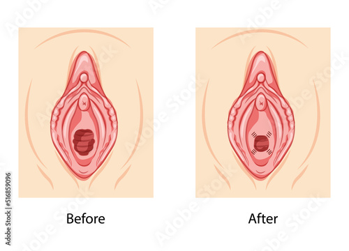 Hymenoplasty before and after Hymen repair restoration revirginization reproductive system uterus. Front view. Human Surface anatomy of perineum external organs scheme, vagina vulva flat style icon