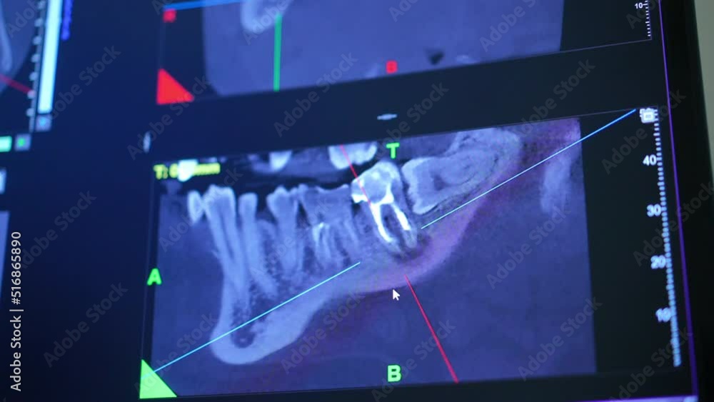 Closeup screen with 3D dental imaging in modern hospital indoors