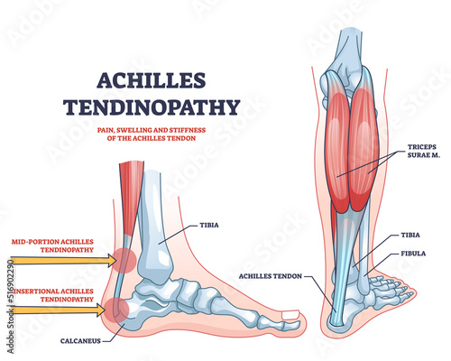 Achilles tendinopathy as injury to tendon in heel outline diagram. Labeled educational scheme with anatomical leg and foot skeleton and muscles vector illustration.Trauma and band of tissue problem. photo
