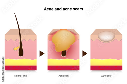 Acne. Diagram of normal skin, acne skin and acne scar. Vector for advertising about beauty and medical treatment.