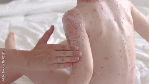 little baby boy with severe form of varicella,chickenpox virus.mother,woman hand applying white foam.kid crying,feeling pain.blisters on child body.nettle rash spread over all body,shoulder,neck hands