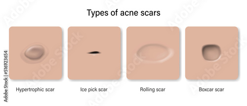 Types of acne scars. Facial skin problems. Hypertrophic scar, Ice pick, Rolling and Boxcar. Vector for advertising about beauty and medical treatment.