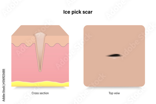 Ice pick scar. Facial skin problems. Vector for advertising about beauty and medical treatment.