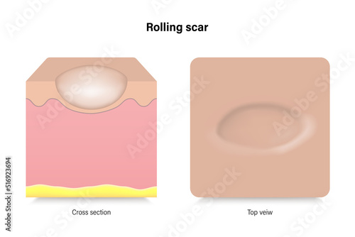 Rolling scar. Facial skin problems. Vector for advertising about beauty and medical treatment.