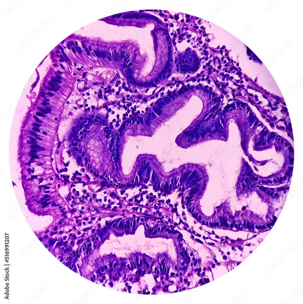 Microscopic Image Of Gastric Carcinoid Tumor Rare Tumors That Develop microscopic-image-of-gastric-carcinoid-tumor-rare-tumors-that-develop