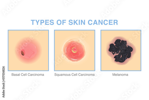 3 Types of skin cancer. Illustration about medical diagram of basal cell carcinoma, squamous cell carcinoma, and Melanoma for diagnosis and treatment of skin lesions.
