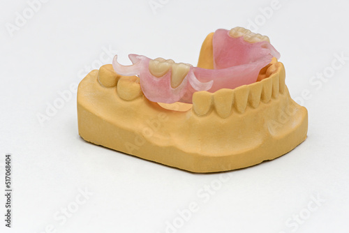 Dentale Prothese in Kunststoff ohne Metall