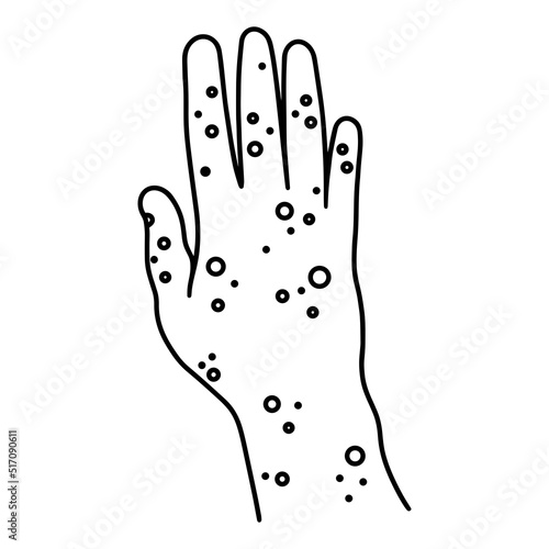 Painful rash on right human hand vector icon. Palm with ulcers, blisters, sores on the skin. Symptom of a viral, allergic disease. Dermatitis, monkeypox, psoriasis, eczema. Outline isolated on white