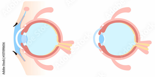 眼球断面図／Cross section of the eyeball