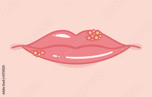 Illustration of herpes labialis seen from the front photo