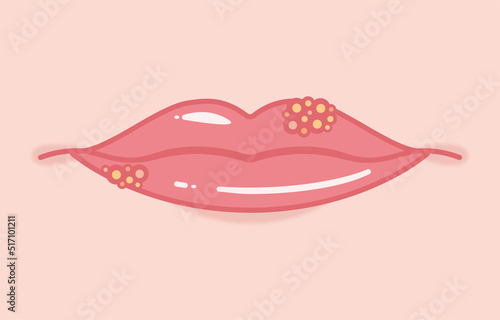 Illustration of herpes labialis seen from the front