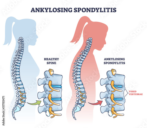 Ankylosing spondylitis as inflammatory spine bone disease outline diagram. Labeled educational anatomical comparison with healthy and damaged vertebrae vector illustration. Fused skeletal back parts.