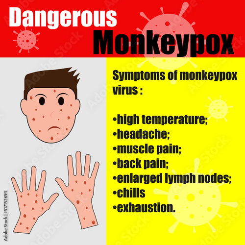 Monkeypox virus zoonotic viral disease that can infect human, nonhuman primates. Monkey pox. Vector illustration