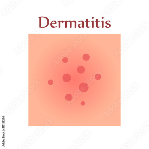 Dermatitis on human skin. Dermatological disease. The symptom is itching, pain, redness and rash. Allergic reaction. Medical diagnostics and treatment. Vector illustration