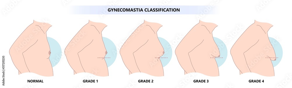 Classification of Gynecomastia Man Obesity with fat tissue on the chest comparison with normal the disorder in medical Classification of Gynecomastia Man Obesity with fat tissue on the chest comparison with normal the disorder in medical