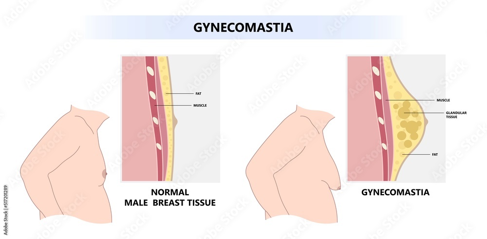 Lateral of Gynecomastia Man Obesity with fat tissue on the chest ...