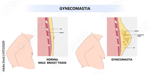 Lateral of Gynecomastia Man Obesity with fat tissue on the chest comparison with normal the disorder in medical