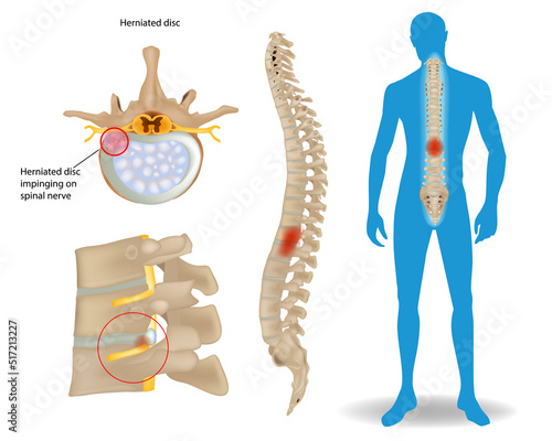 Spinal Disc Herniation. Back Pain Human. Spinal Cord Compression. Bulging disc. Orthopaedic