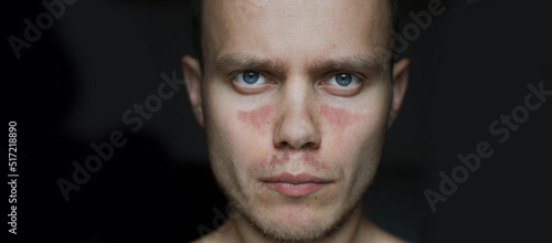 Obraz na płótnie man with allergic dermatitis, red spots on his face. Autoimmune disease lupus. w salonie