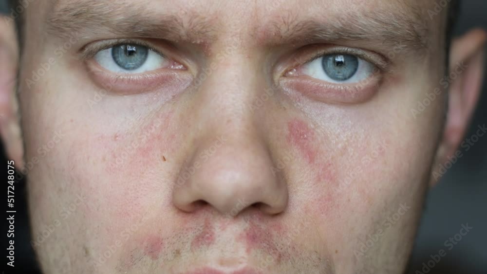 young man with redness and allergic dermatitis on his face. young man with redness and allergic dermatitis on his face.