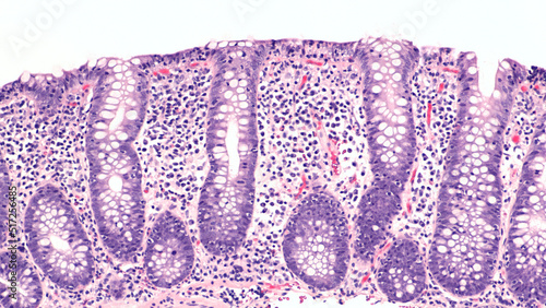 Fotografi Photomicrograph of lymphocytic colitis, a type of microscopic colitis, showing increased numbers of intraepithelial lymphocytes