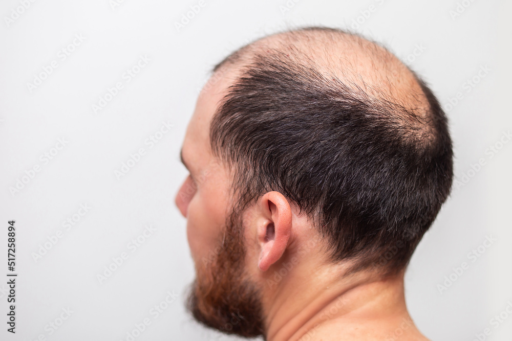 male head with thinning hair or alopecia Stock Photo | Adobe Stock
