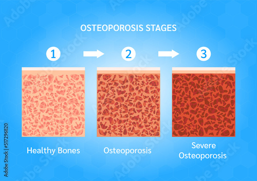 Osteoporosis stages. Bone structure normal and osteoporosis. Medical check up health concept. Isolated on a blue background. Vector EPS10 illustration.