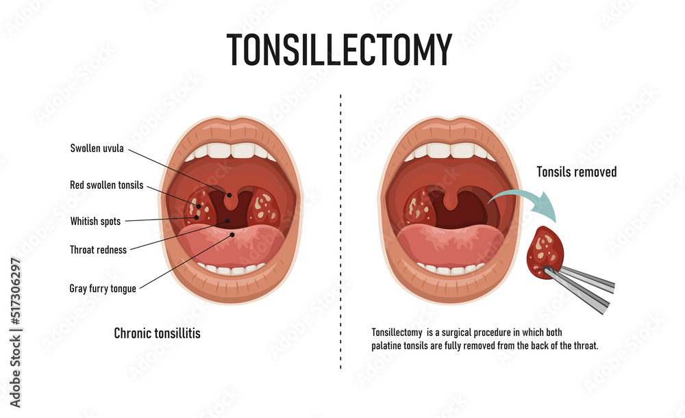 Tonsillectomy. Removal of palatine tonsils. Acute pharyngitis Stock