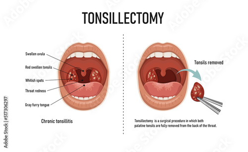 Tonsillectomy. Removal of palatine tonsils. Acute pharyngitis photo